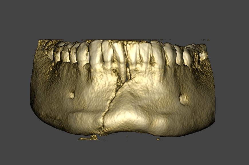 Tomografía Mandibular