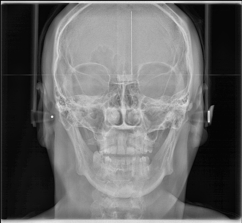 Radiografía Senos Maxilares