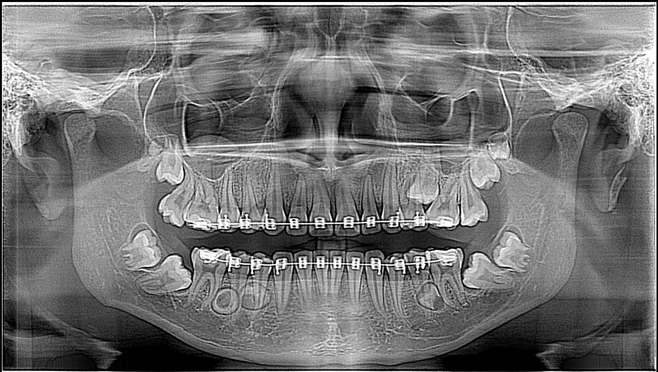 Radiografía Panoramica